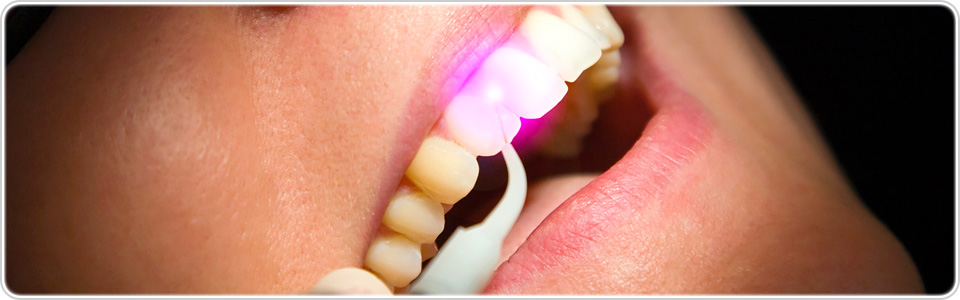 レーザー治療＋歯周内科治療＋殺菌水による高度歯周病治療