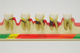 歯周病の進行