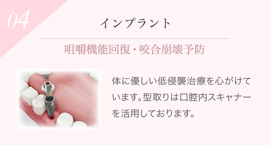 インプラント