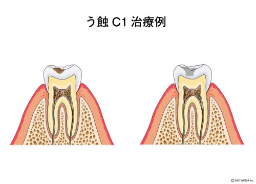 むし歯 Ｃ1