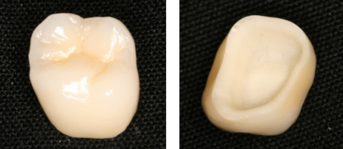 オールジルコニアクラウン