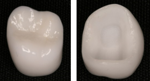 オールセラミッククラウン