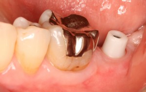 平田11 土台装着