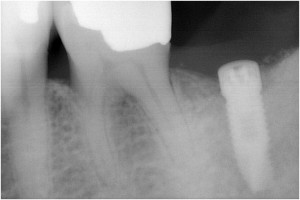 平田8 2次オペ時・埋入後約3ヶ月