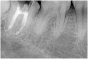 戸田２根管充填