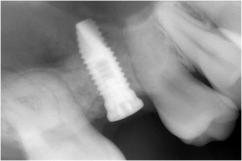 田村7 埋入後約3ヶ月
