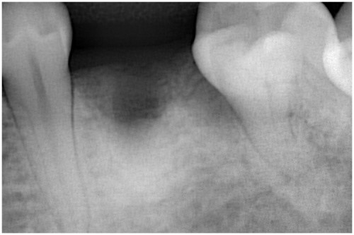 阿久井3 抜歯後約1.5ヶ月