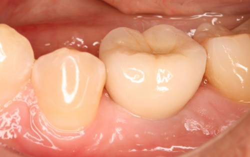 阿久井9 上部構造装着